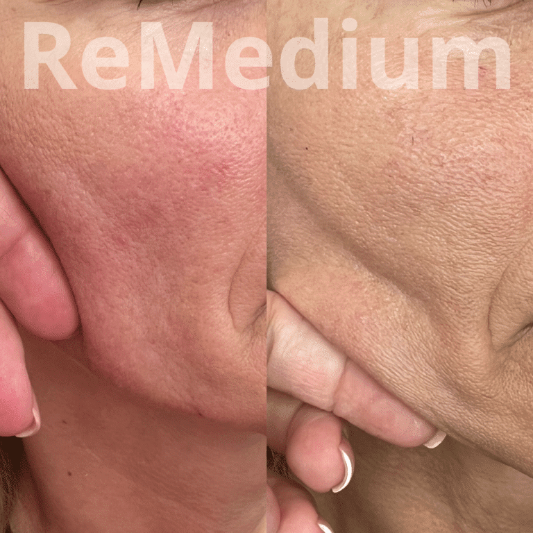 ReMedium PDRN (3x2ml) BIOSTYMULATOR - obrazek 6
