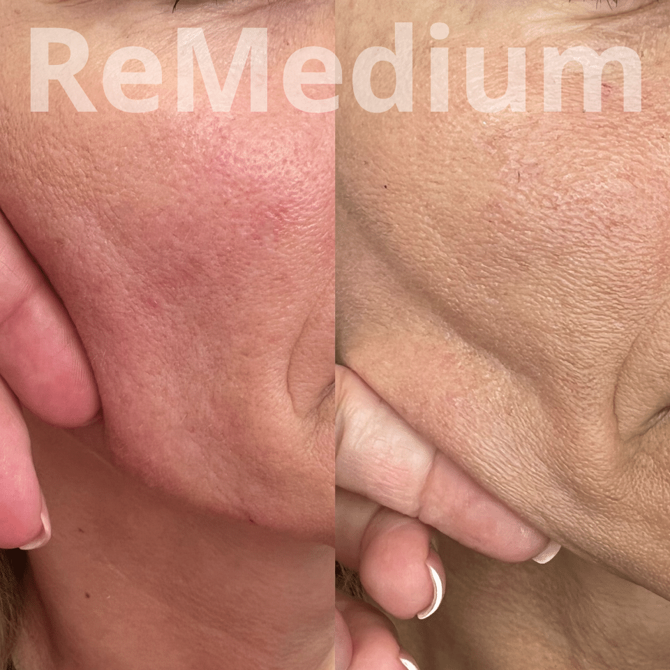 ReMedium PDRN (3x2ml) BIOSTYMULATOR - obrazek 6