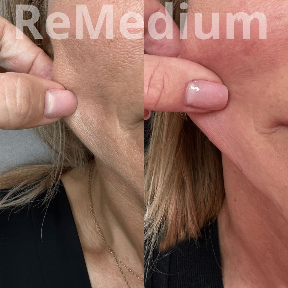 ReMedium PDRN (3x2ml) BIOSTYMULATOR - obrazek 5